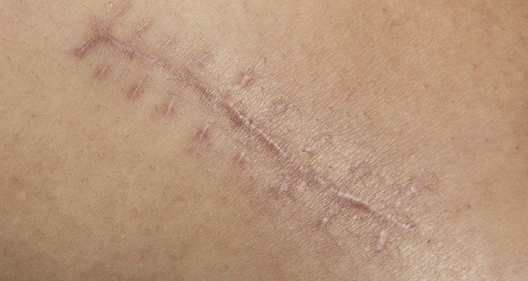 The scar