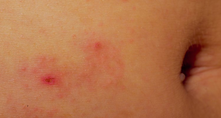 eczema atopic dermatitis symptom skin