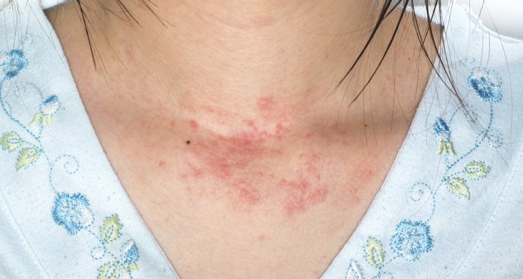 eczema skin on neck